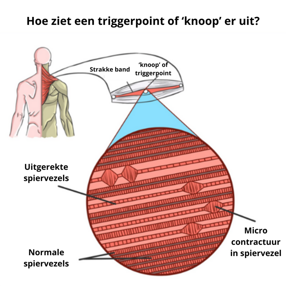 Triggerpoint, spanning, spieren